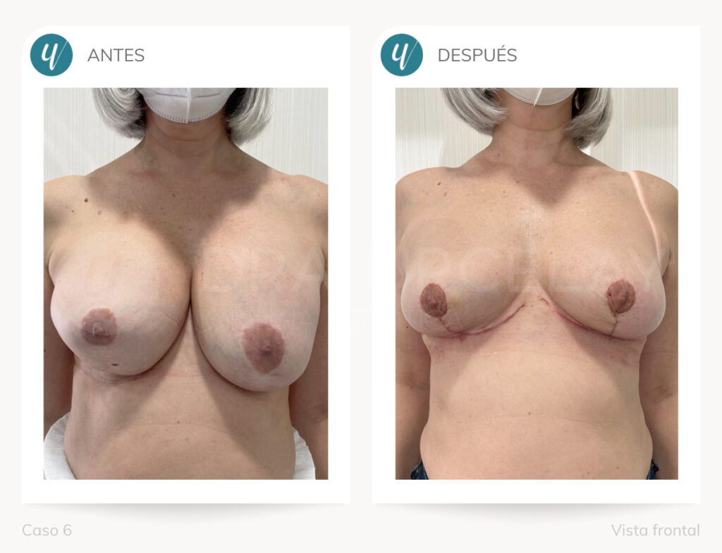Caso de elevación mamaria. Doctora Urcelay en Madrid.