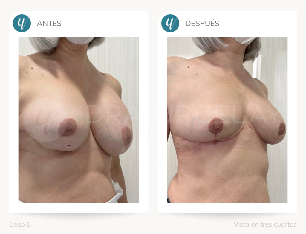 Caso de elevación mamaria. Doctora Urcelay en Madrid.