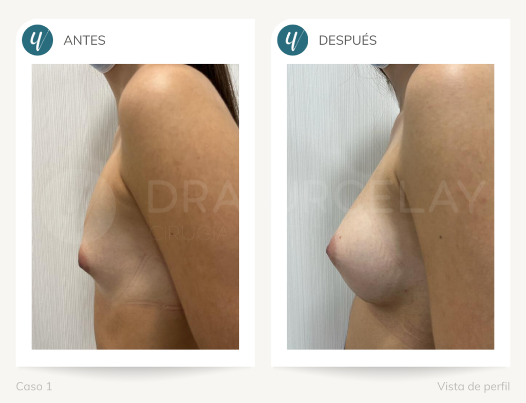 Cirugía de aumento de mama en Madrid
