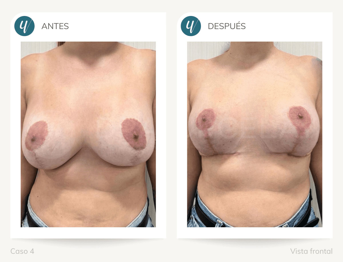 Caso de elevación de mamas. Doctora Urcelay en Madrid.