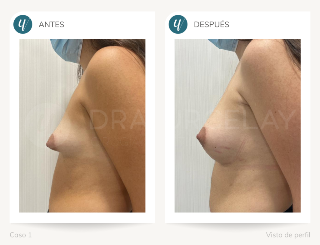 Antes y después de corrección de mamas tuberosas