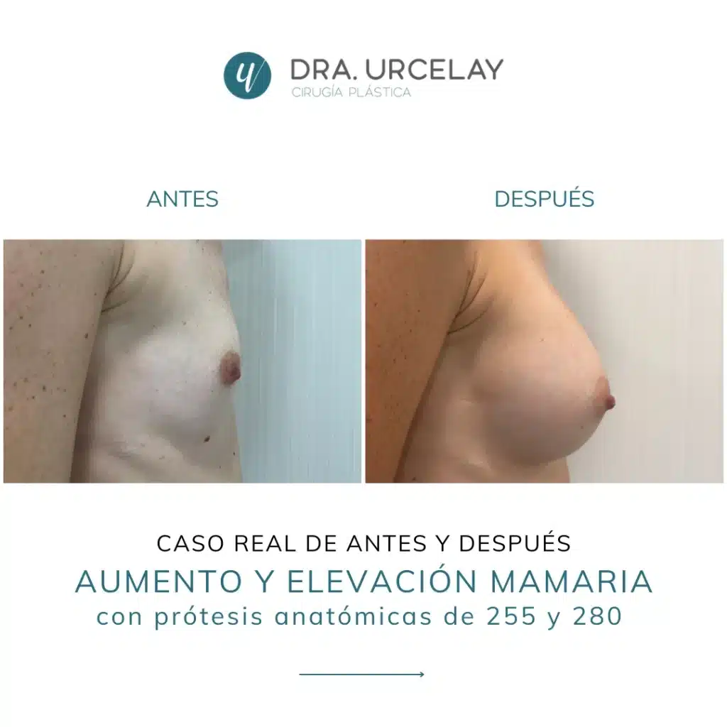 Cirugía de aumento y elevación mamaria en Madrid, caso real y resultado