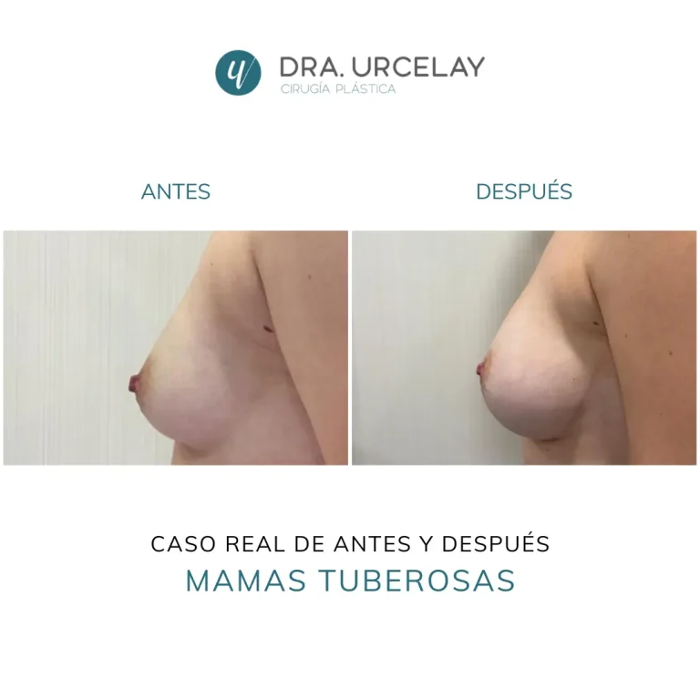 Cirugía de mamas tuberosas en Madrid, caso real y resultado