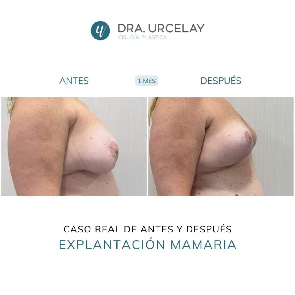 Caso real de antes y después de explantación de prótesis en Madrid
