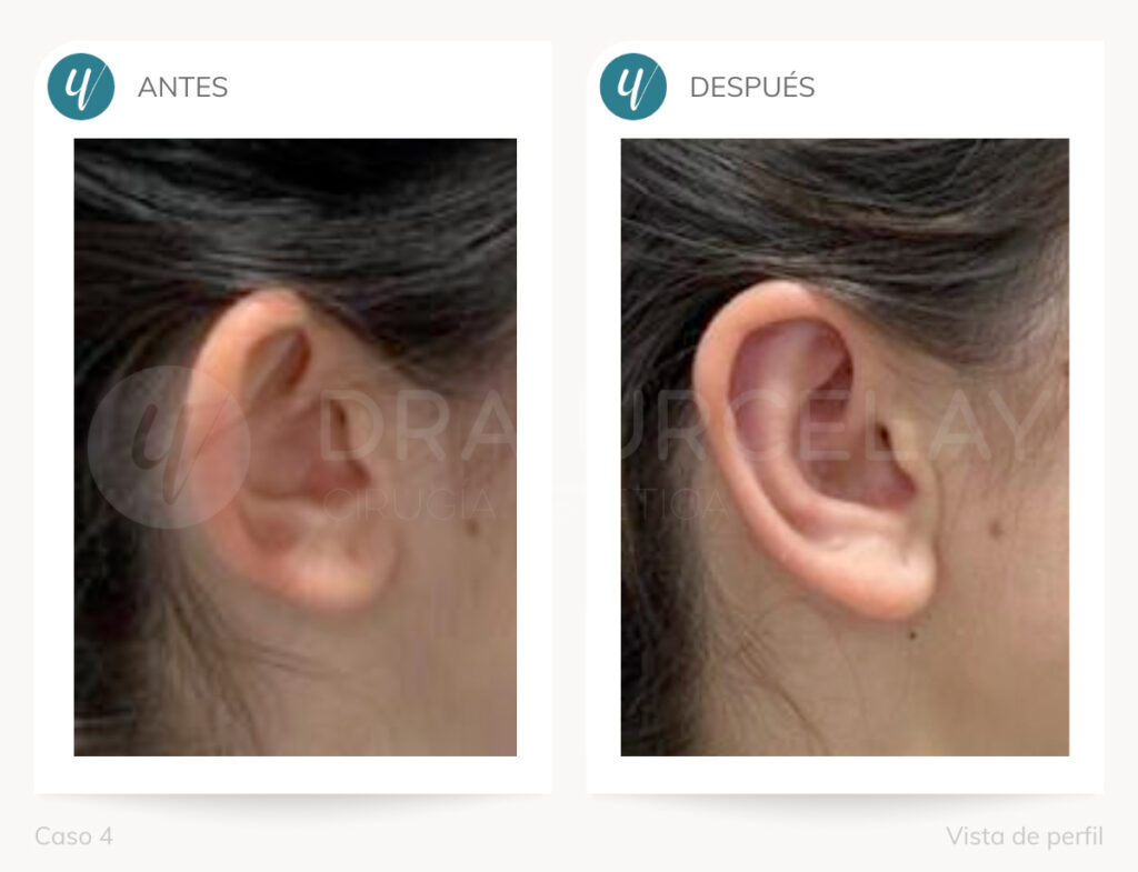 Corrección de orejas despegadas en Madrid