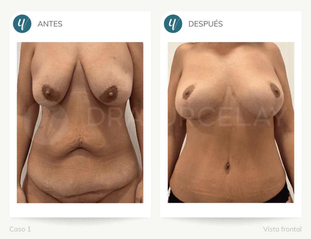 Cirugía Post-bariátrica en Madrid antes y después