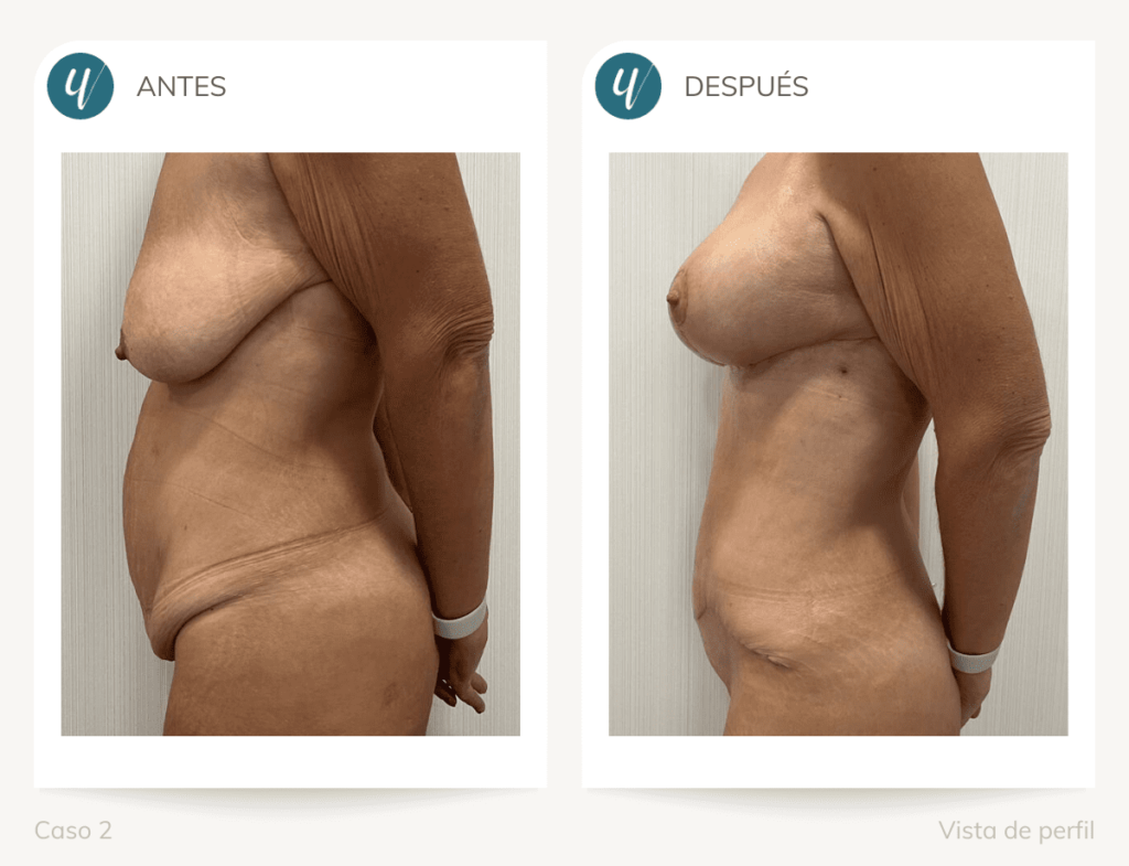 Antes y después de cirugía Post-bariátrica en Madrid