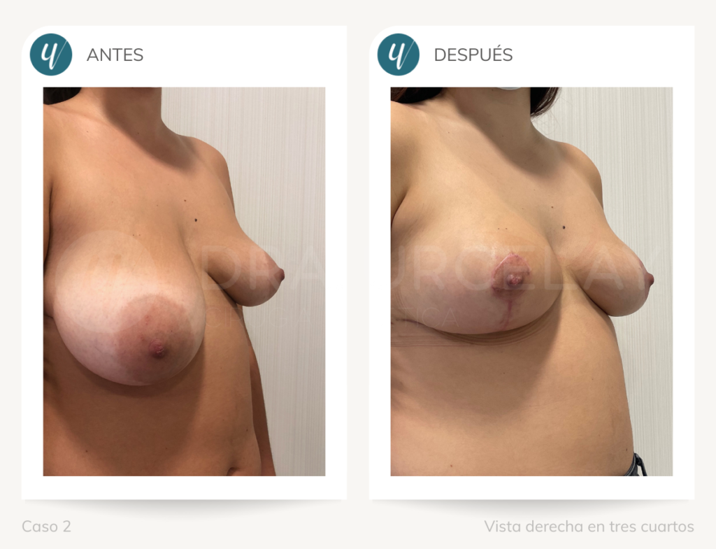 Resultado de cirugía de asimetría mamaria