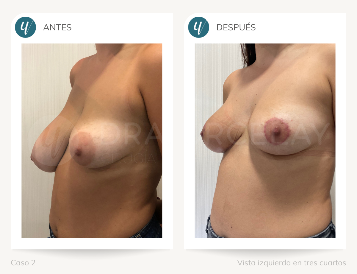 Antes y después de asimetría mamaria