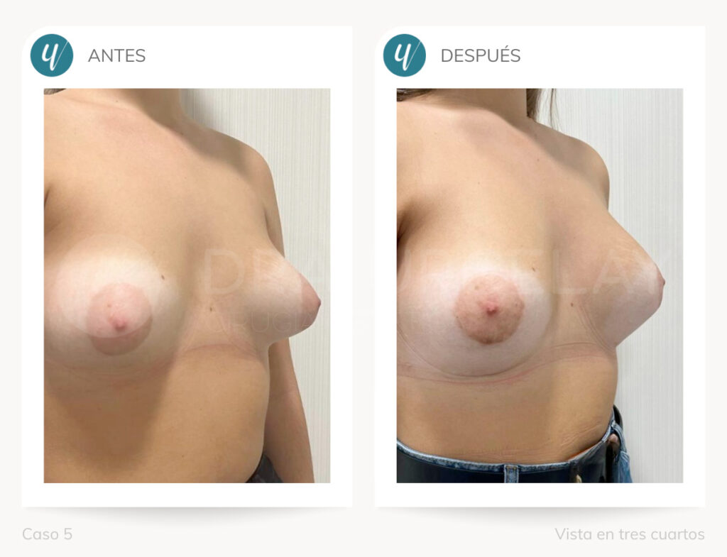 Cirugía de corrección de mamas tuberosas.