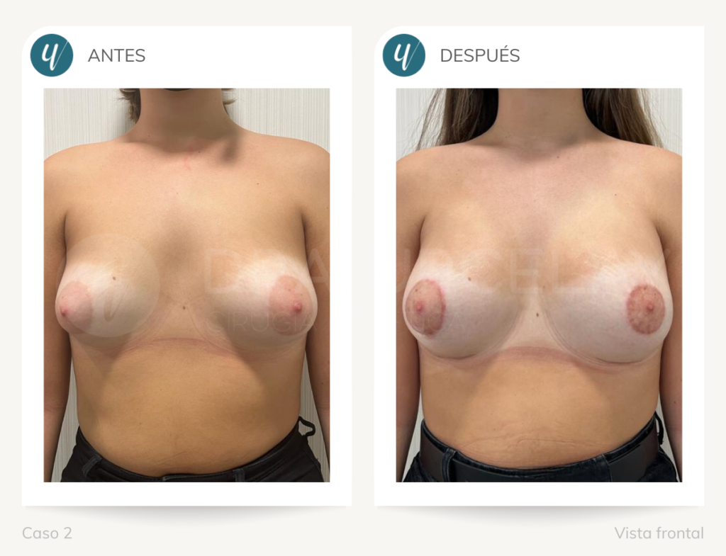 Cirugía de corrección de mamas tuberosas