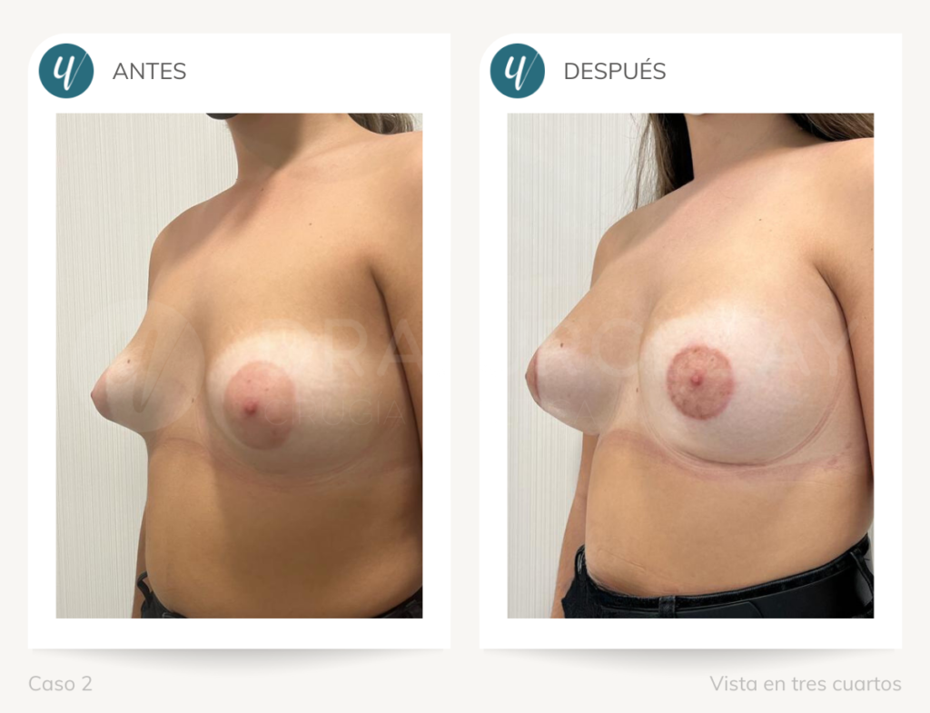 Antes y después de cirugía de corrección de mamas tuberosas