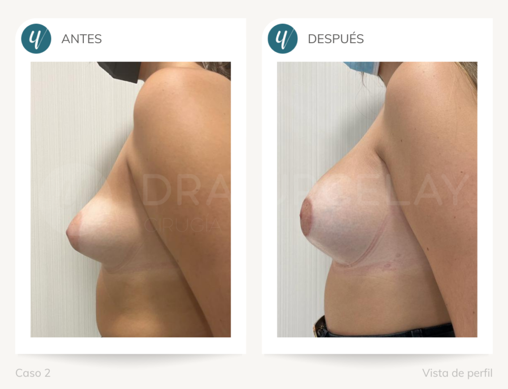 Resultado de cirugía de corrección de mamas tuberosas