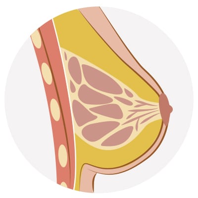 Cirugía de solución de mamas tuberosas