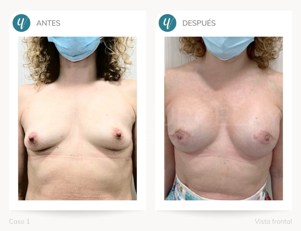 Cirugía de reconstrucción mamaria en Madrid