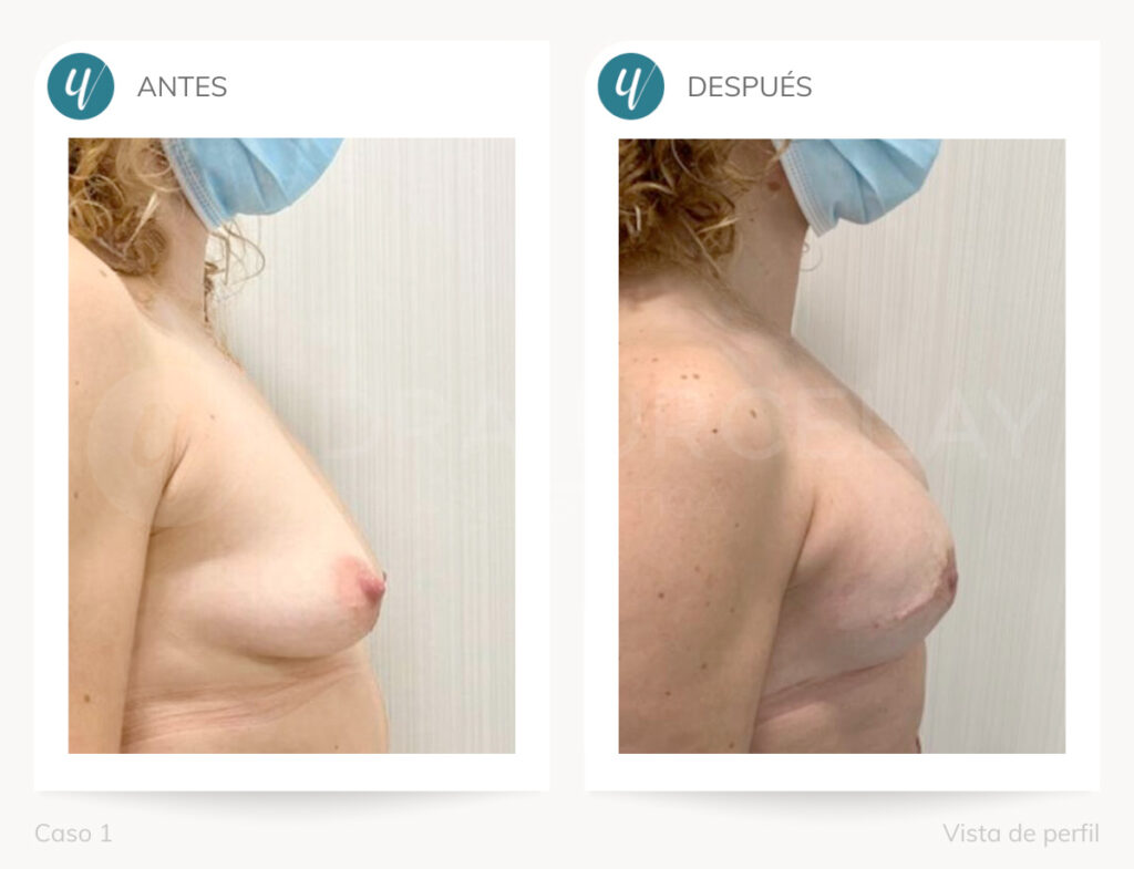 Cirugía de reconstrucción mamaria en Madrid