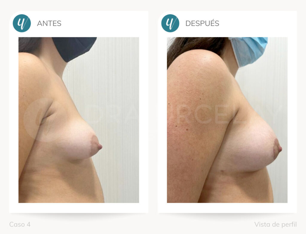 Corrección de mamas tuberosas en Madrid
