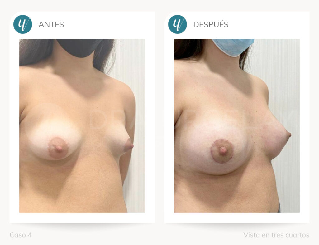 Corrección de mamas tuberosas en Madrid