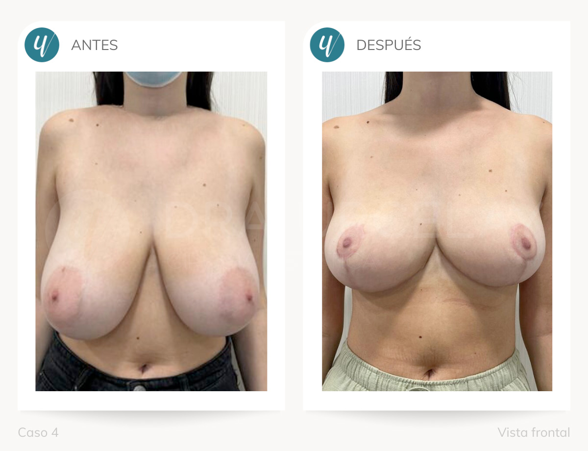 Cirugía de reducción de pecho de la cirujana Dra. Urcelay en Madrid.
