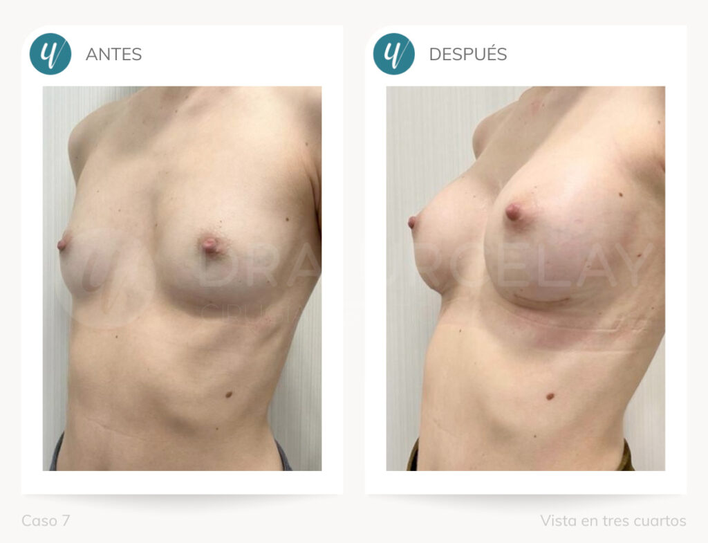 Caso de aumento de mamas. Doctora Urcelay en Madrid.