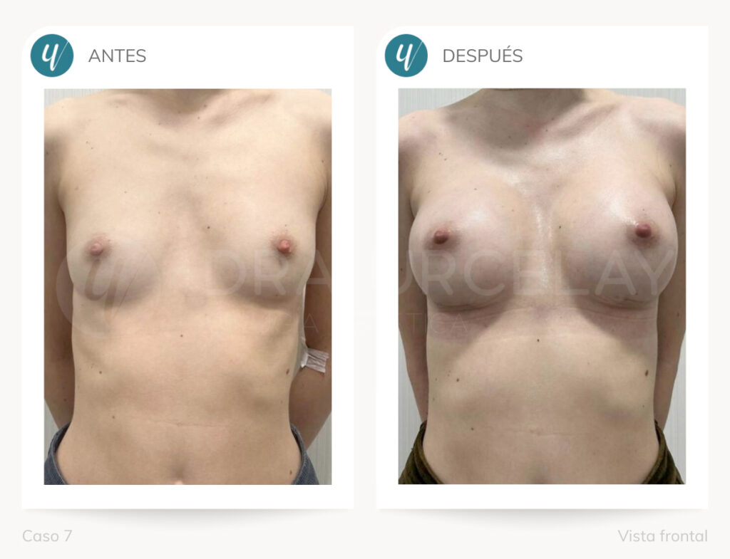 Caso de aumento de mamas. Doctora Urcelay en Madrid.