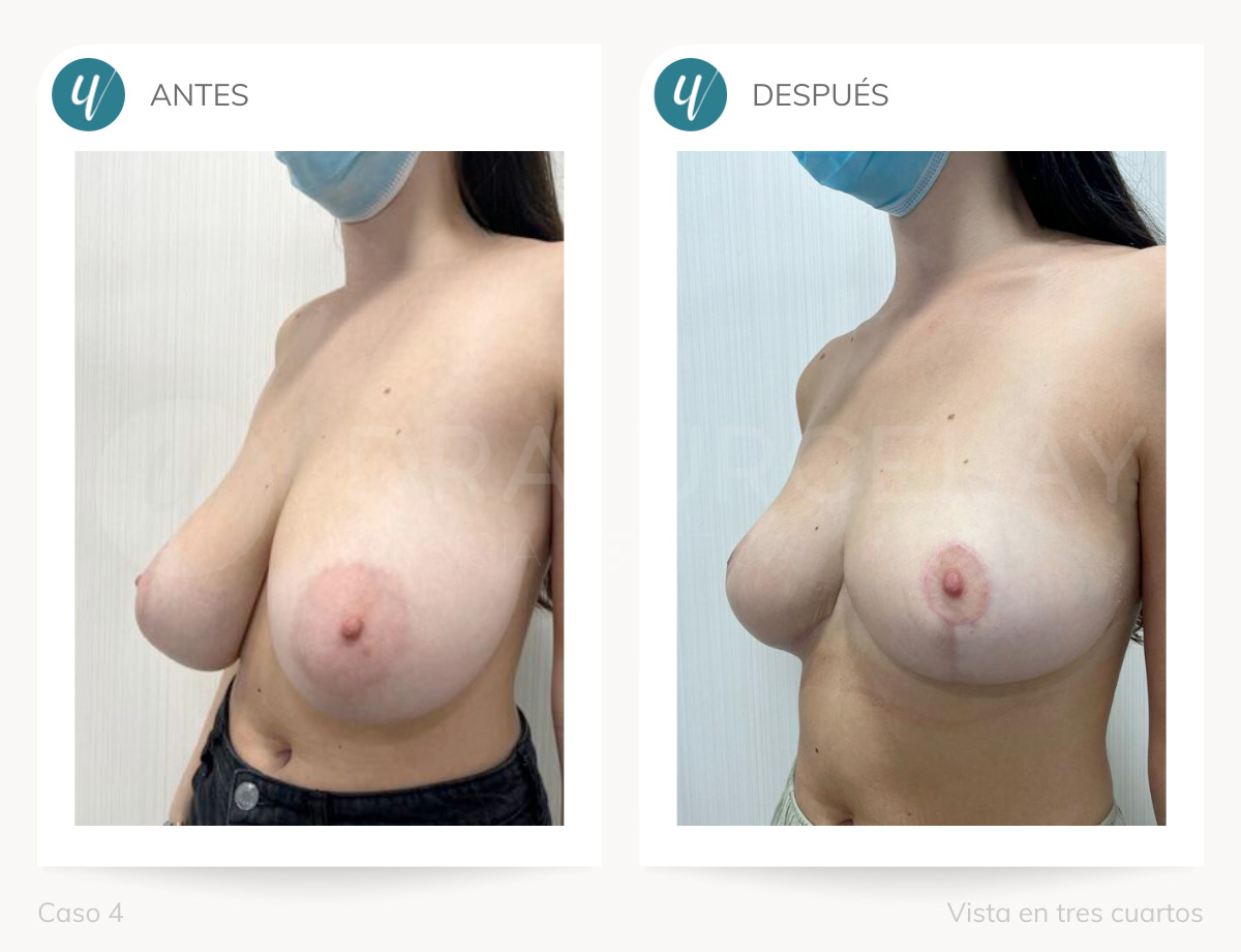 Cirugía de reducción de pecho de la cirujana Dra. Urcelay en Madrid.