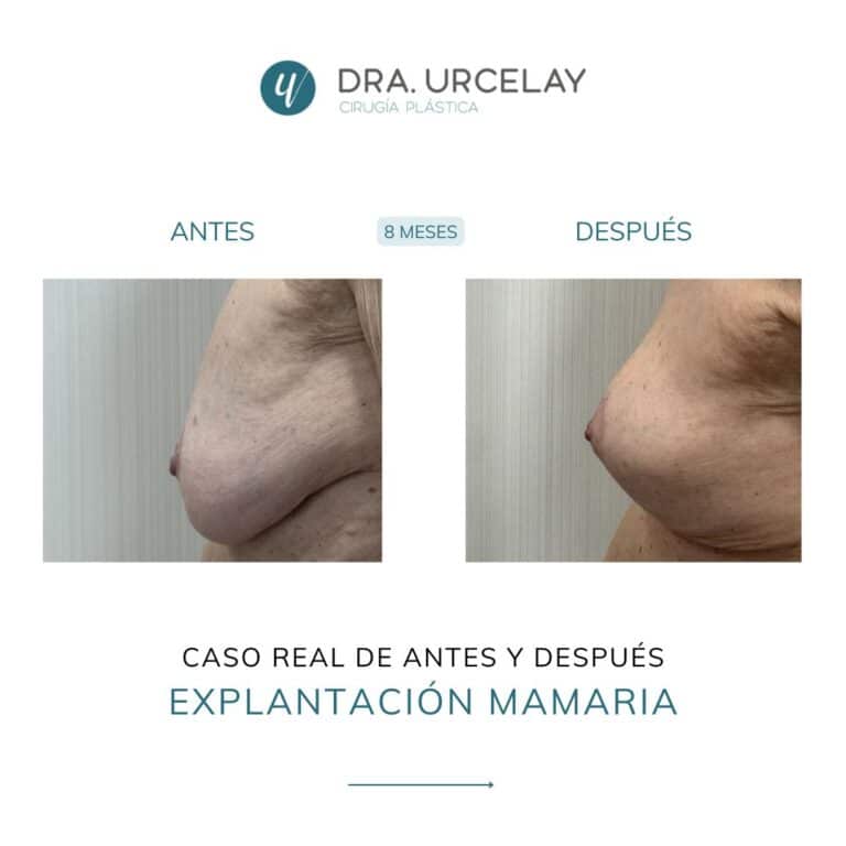 Caso real de antes y después de explantación de prótesis en Madrid