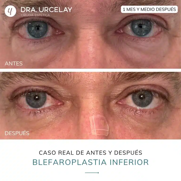Cirugía de blefaroplastia inferior en Madrid, caso real y resultado