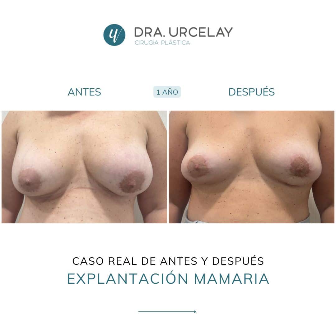 Caso real de antes y después de explantación de prótesis en Madrid