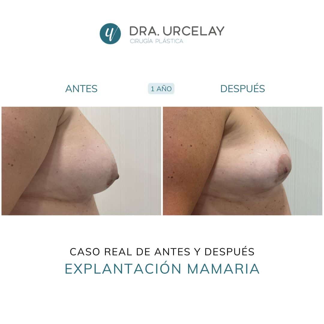 Caso real de antes y después de explantación de prótesis en Madrid