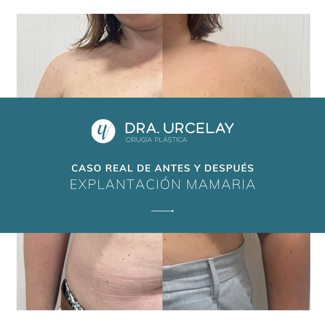 Caso real de antes y después de explantación de prótesis en Madrid