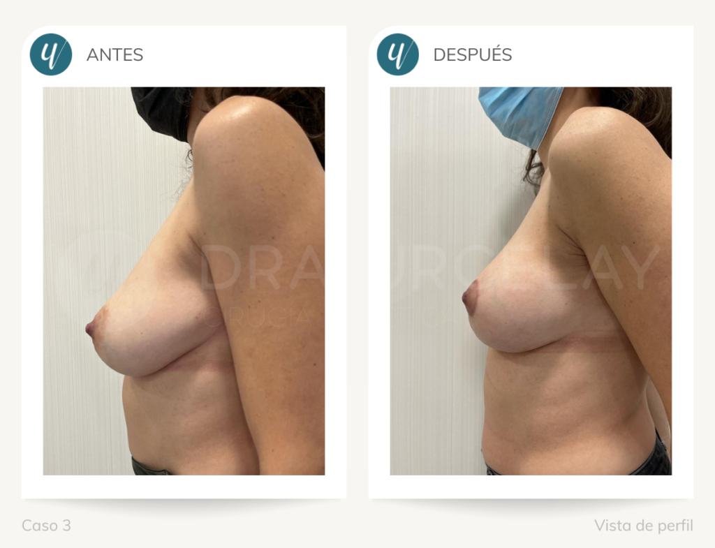 Antes y después mamoplastia de reducción