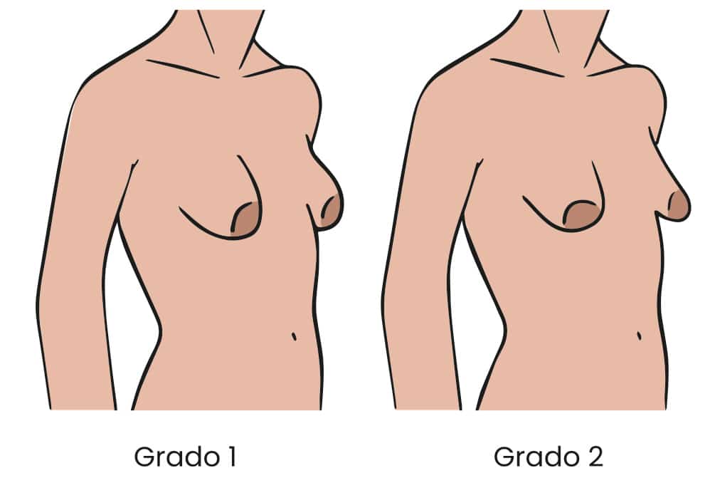 Grados de mamas tuberosas