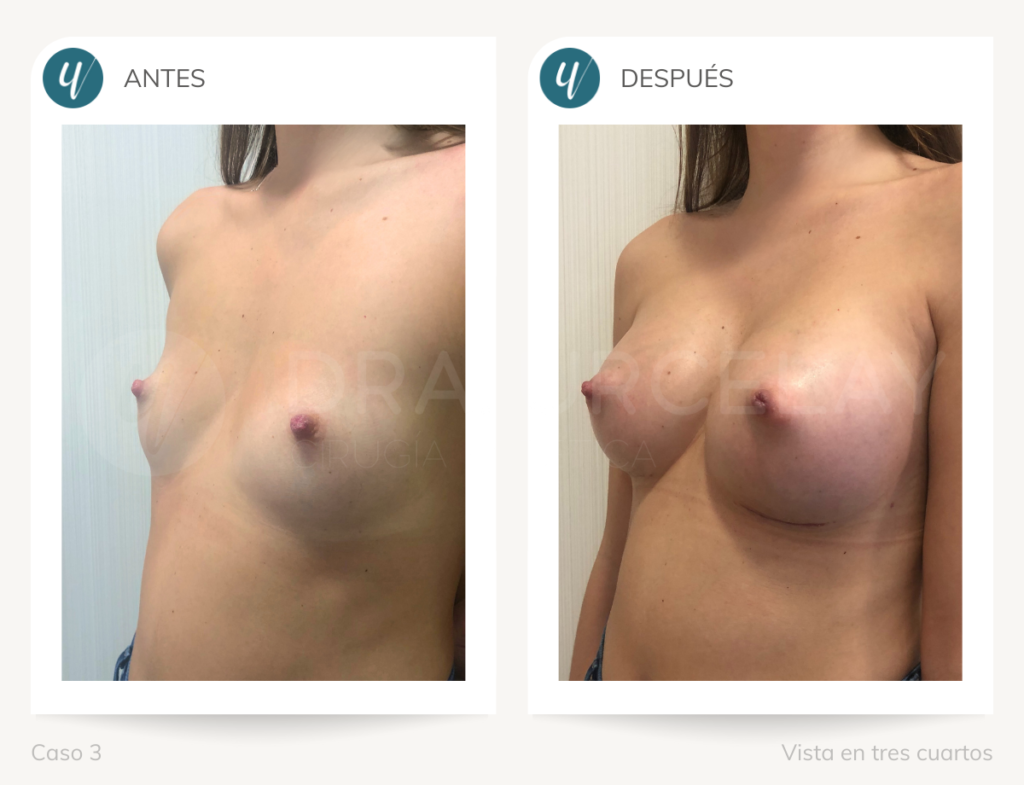 Cirugía de aumento de mamas