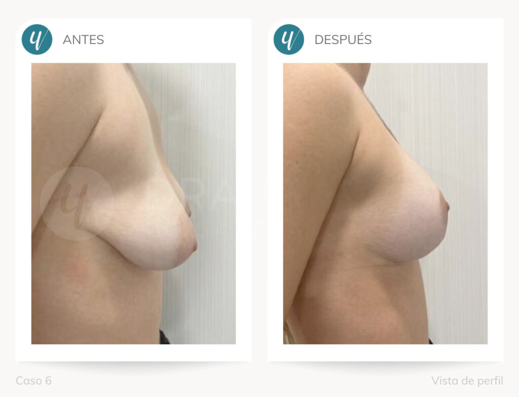 Cirugía de corrección de mamas tuberosas.