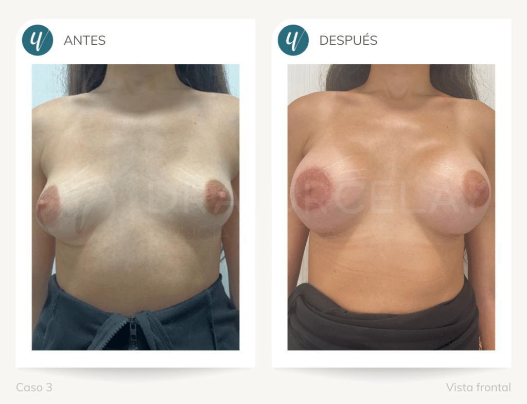 Operación de corrección de mamas tuberosas