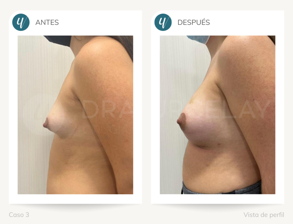 Resultados de operación de corrección de mamas tuberosas
