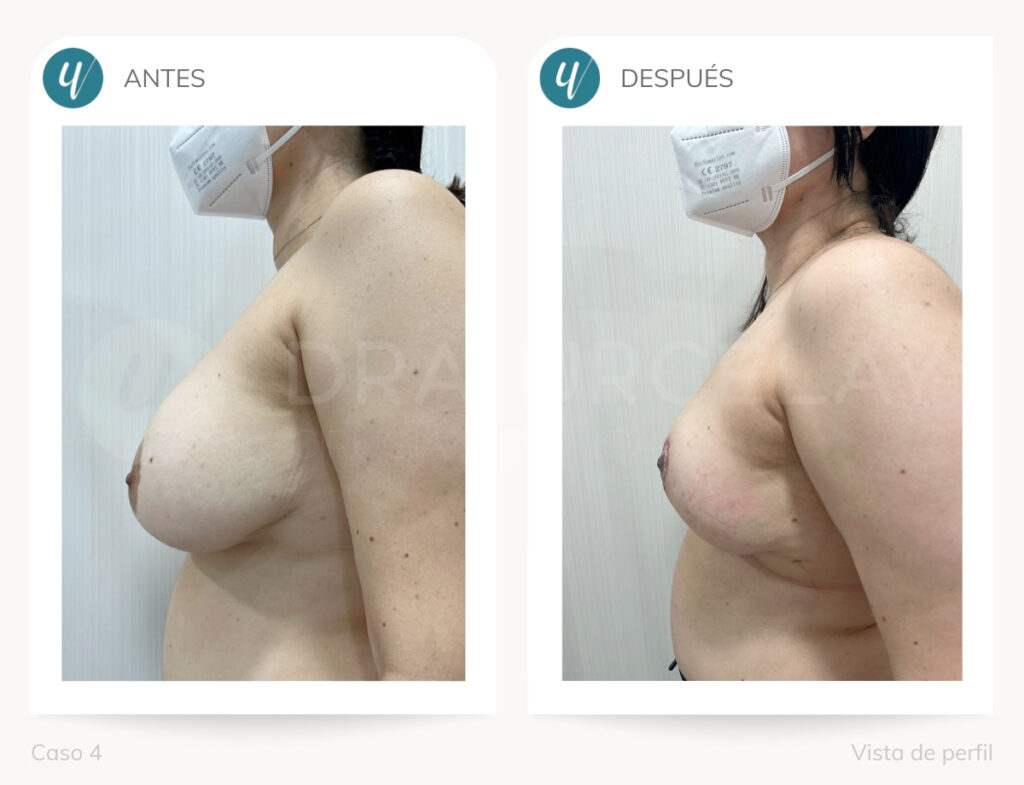 Resultados de explantación de prótesis en Madrid Doctora Urcelay