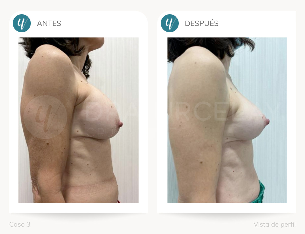 Cirugía de explantación de prótesis en Madrid Doctora Urcelay