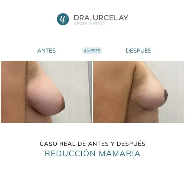 Cirugía de reducción de pecho en Madrid