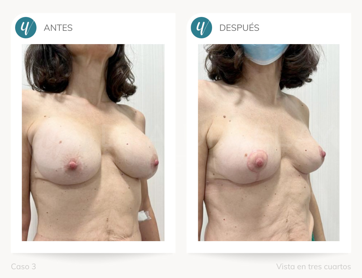 Cirugía de explantación de prótesis en Madrid Doctora Urcelay