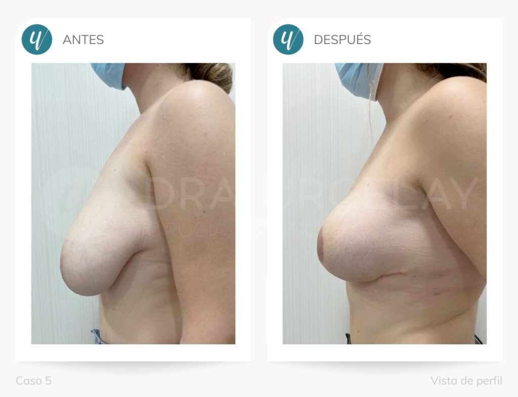 Operación de reducción de pecho de la cirujana Dra. Urcelay en Madrid.
